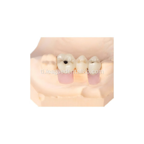 Anatomical Implant Restoration Crown